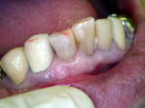 大きな虫歯を樹脂で詰めて治療